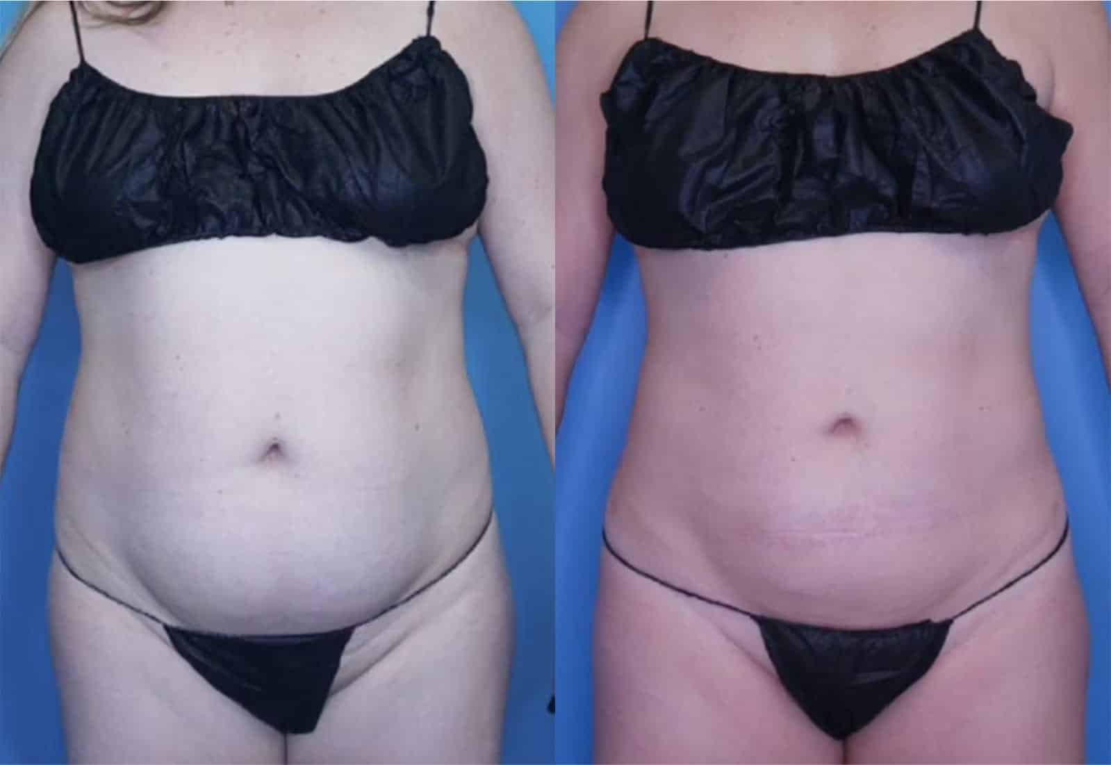 Before and After Image: Vaser Liposuction - front