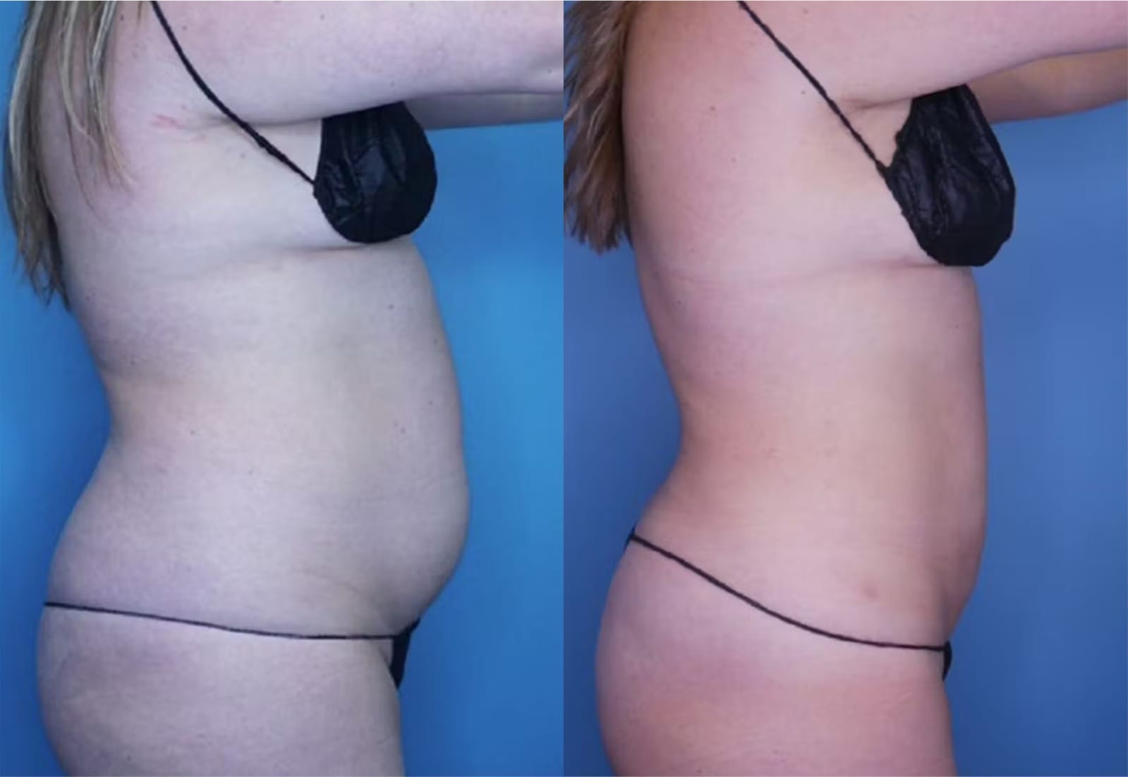 Before and After Image: Vaser Liposuction - right-side