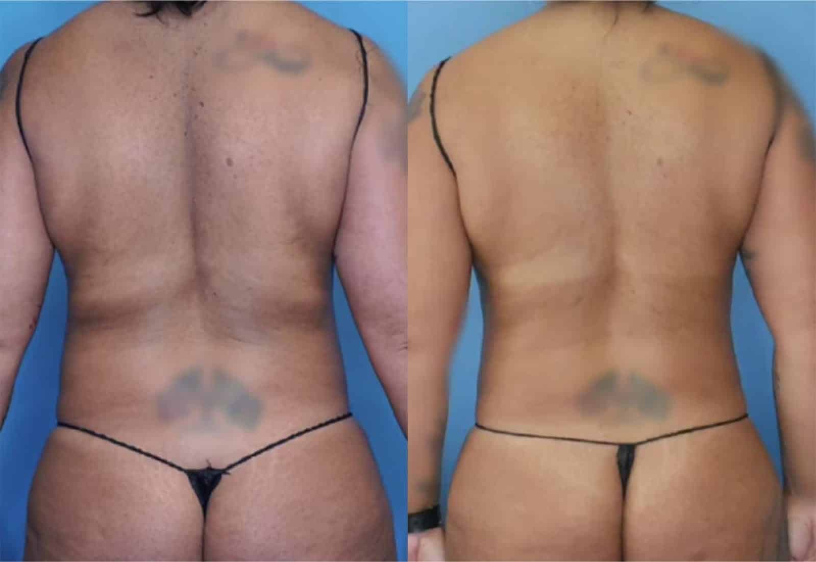 Before and After Image: Vaser Liposuction - back