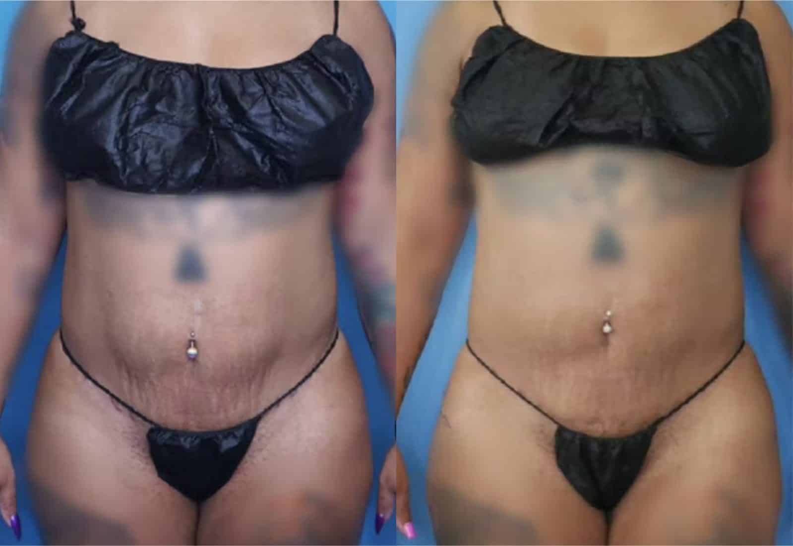 Before and After Image: Vaser Liposuction - front