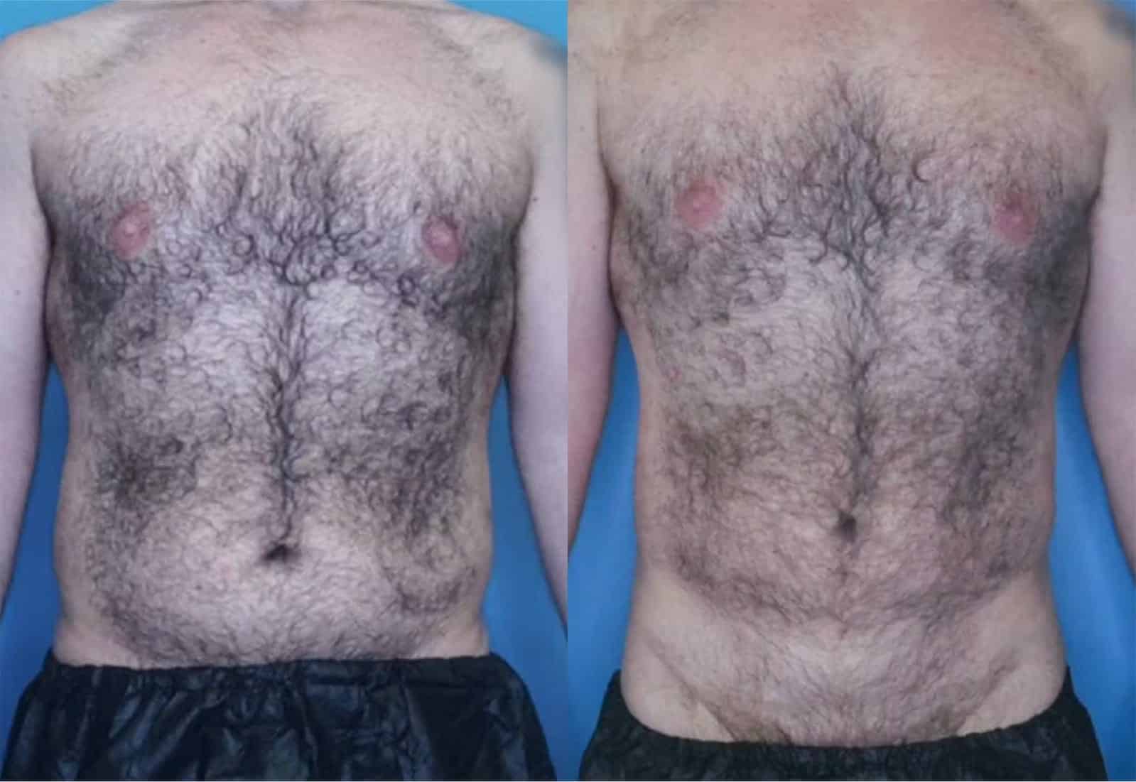 Before and After Image: Vaser Liposuction - front