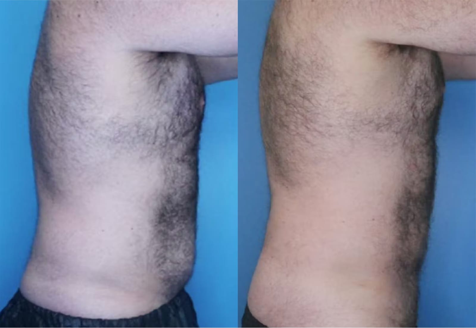 Before and After Image: Vaser Liposuction - right-side