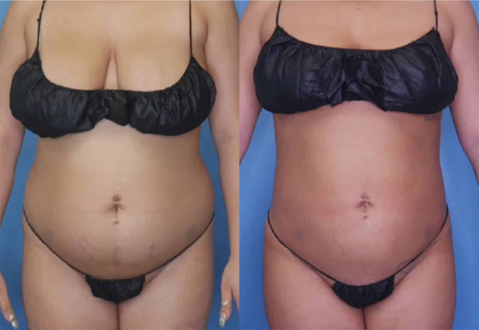 Before and After Image: Vaser Liposuction - front