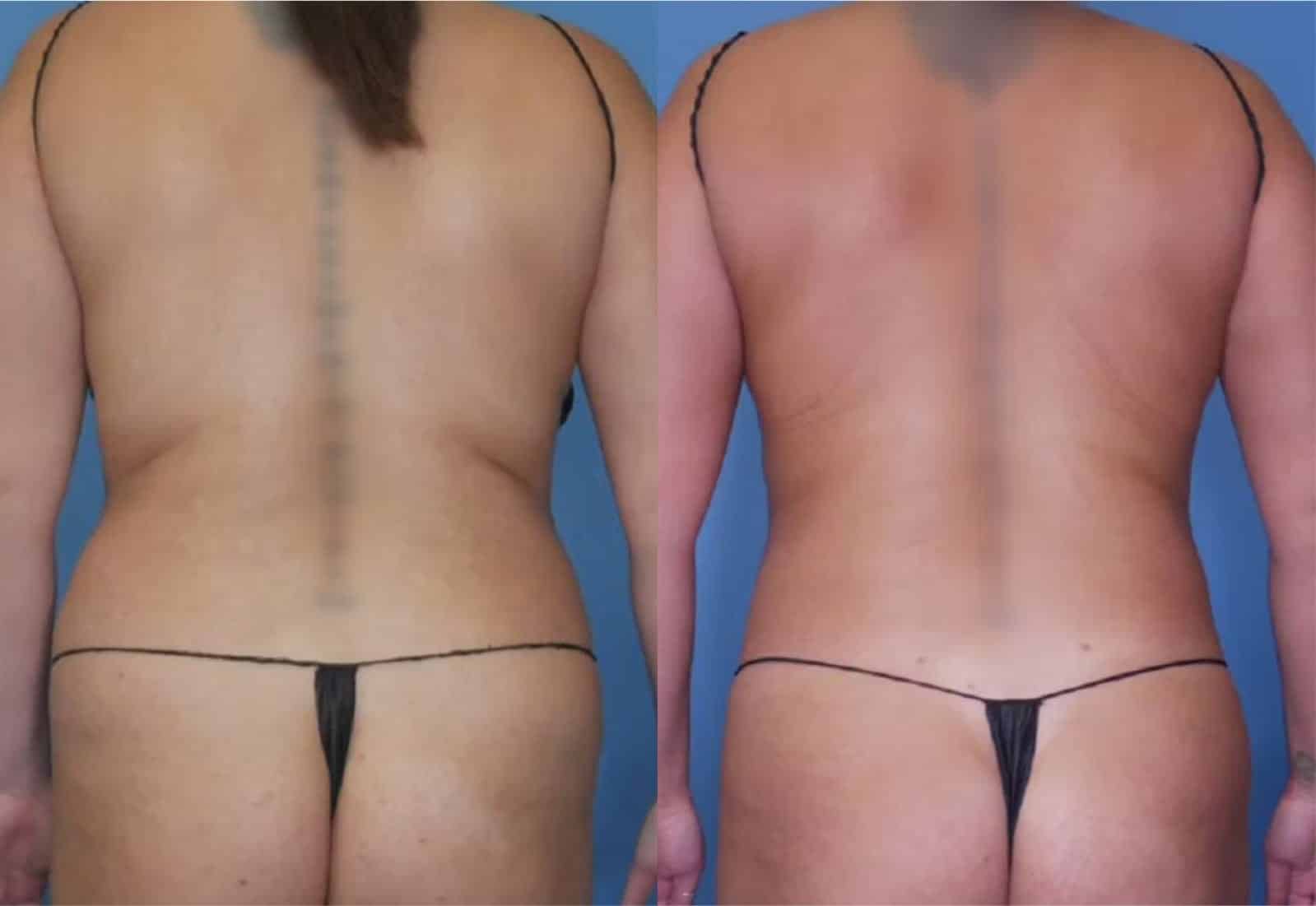 Before and After Image: Vaser Liposuction - back