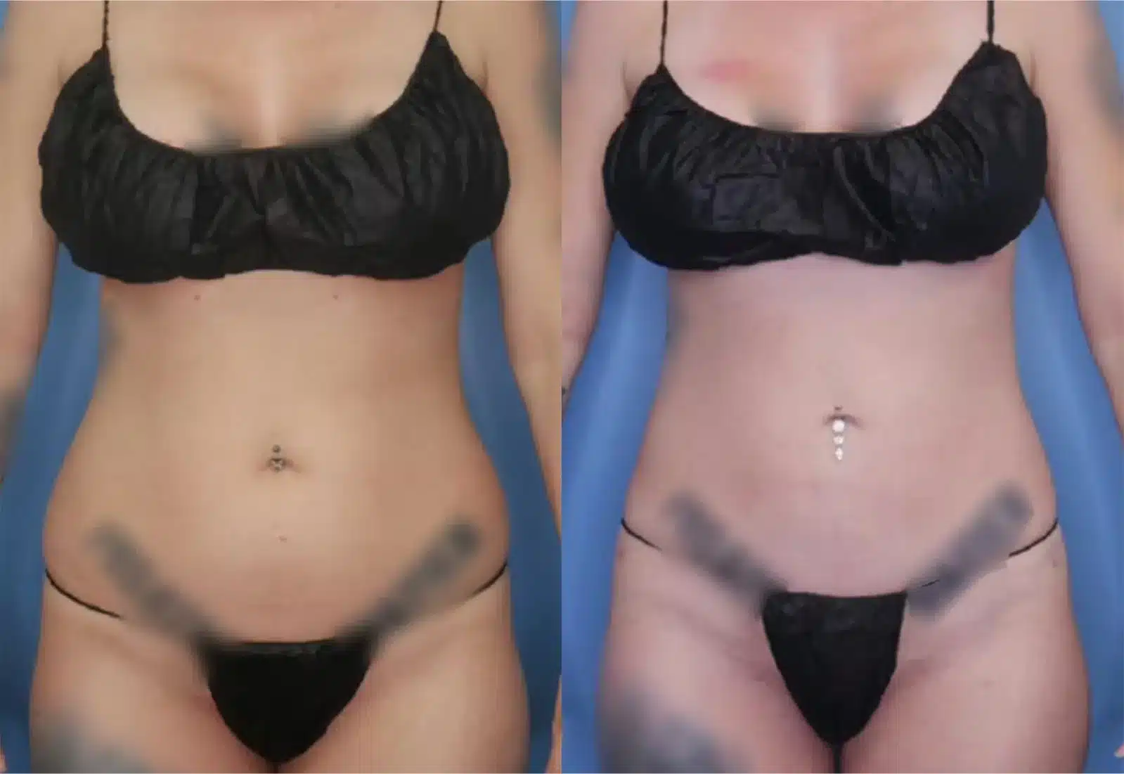 Before and After Image: Vaser Liposuction - front