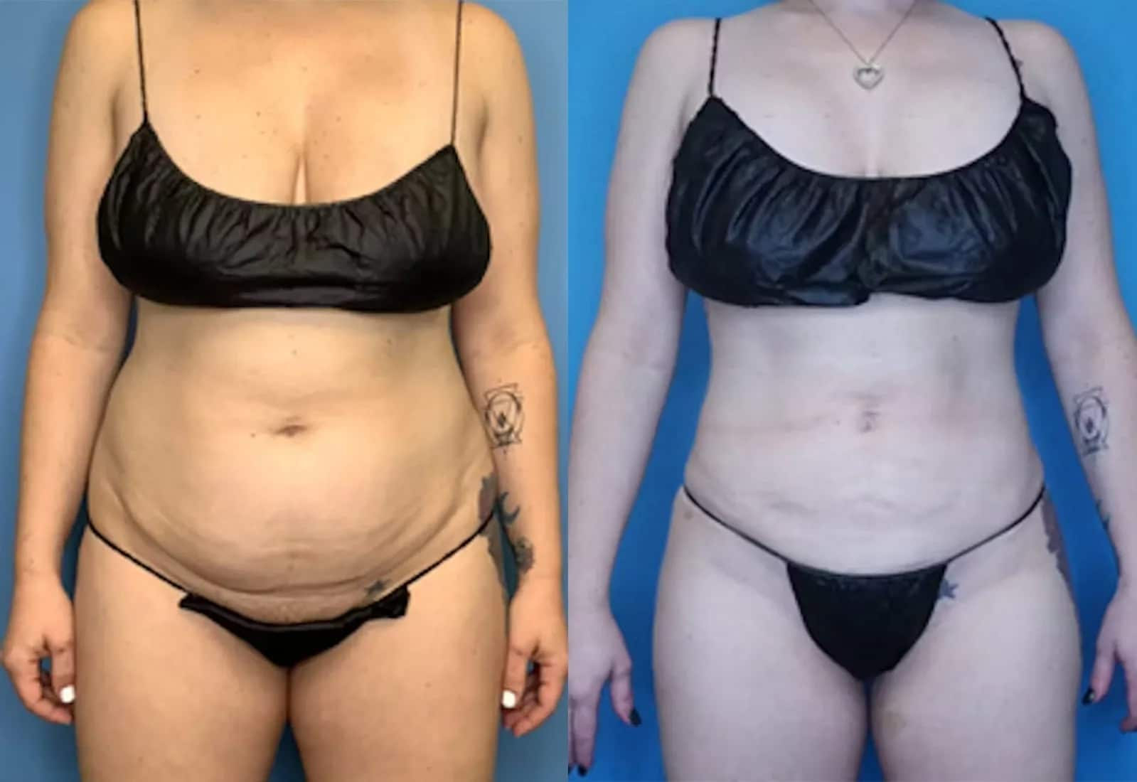 Before and After Image: Vaser Liposuction - front