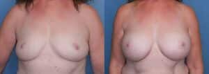 Breast Augmentation in Denver, CO