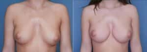 Breast Augmentation in Denver, CO