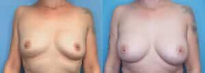 Breast Augmentation in Denver, CO