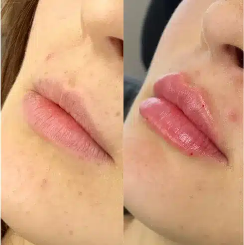 Before and After Image: Lip Fillers - left-front-oblique