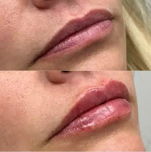 Before and After Image: Lip Fillers - right-front-oblique