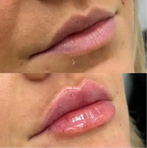 Before and After Image: Lip Fillers - right-front-oblique