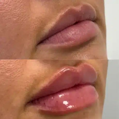 Before and After Image: Lip Fillers - right-front-oblique