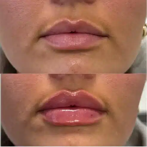 Before and After Image: Lip Fillers - front