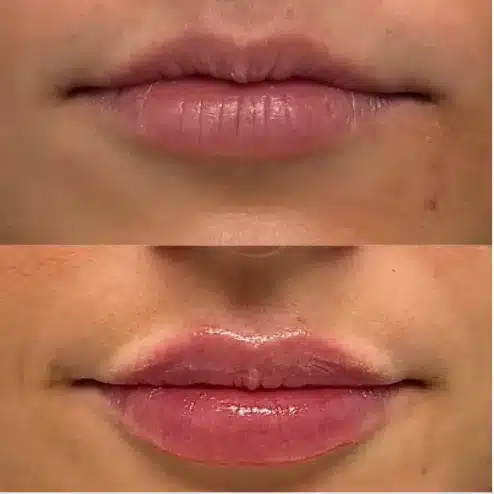 Before and After Image: Lip Fillers - front