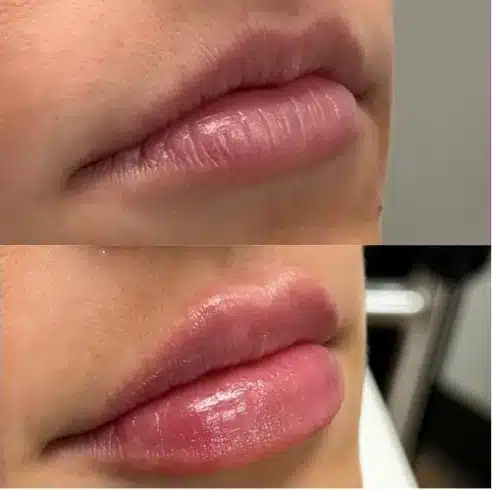 Before and After Image: Lip Fillers - right-front-oblique