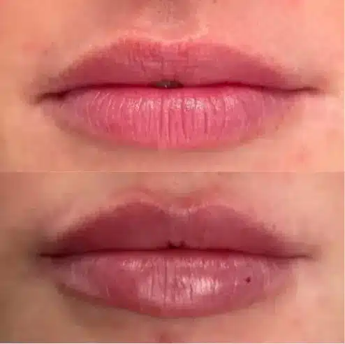 Before and After Image: Lip Fillers - front