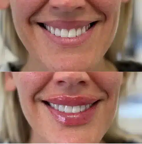 Before and After Image: Lip Fillers - front