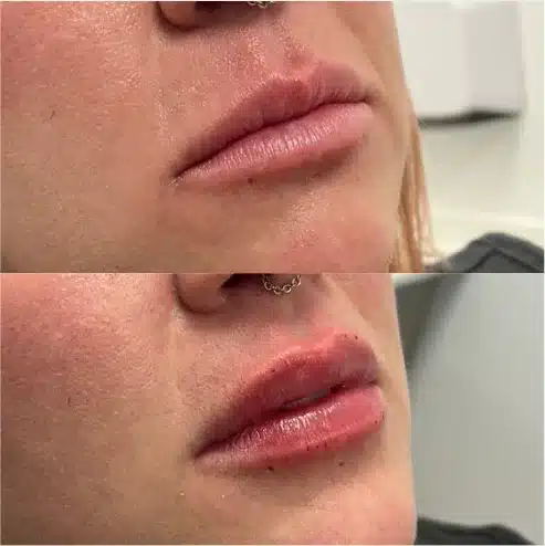 Before and After Image: Lip Fillers - right-front-oblique