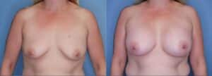 Breast Augmentation in Denver, CO