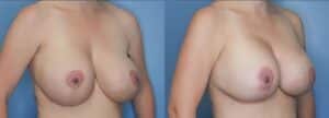 Breast Augmentation in Denver, CO