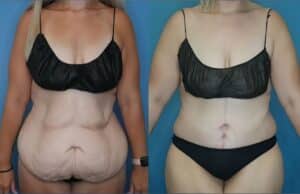 Breast Lift in Denver, CO