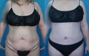 Breast Lift in Denver, CO