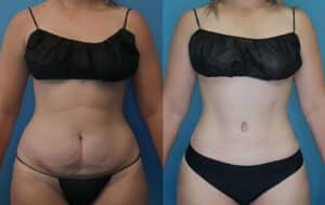 Breast Lift in Denver, CO