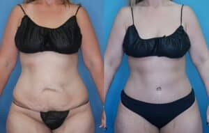 Breast Lift in Denver, CO