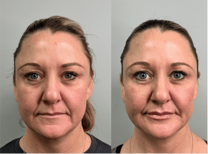 Before and After Image: Under Eye Filler - front