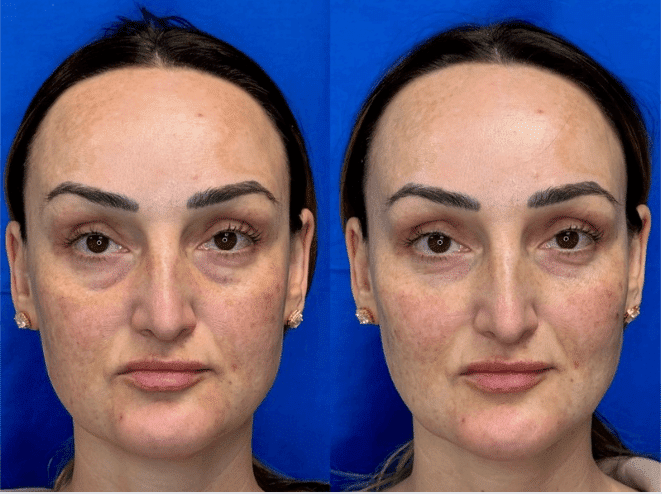 Before and After Image: Under Eye Filler - front