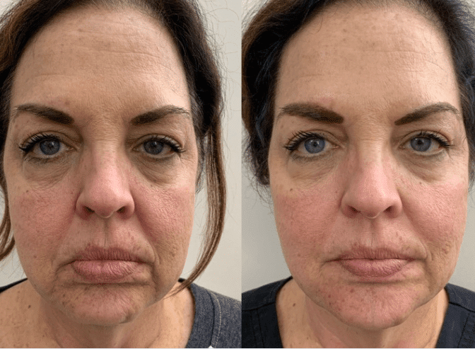 Before and After Image: Under Eye Filler - front