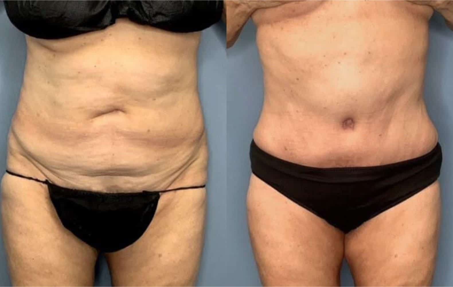 Tummy Tuck Landing Page