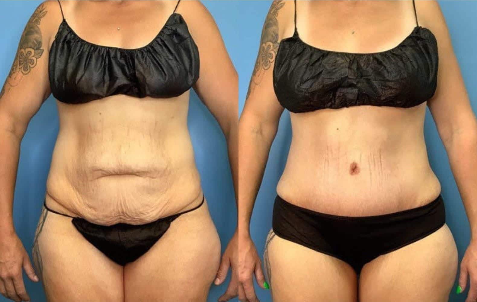 Tummy Tuck Landing Page