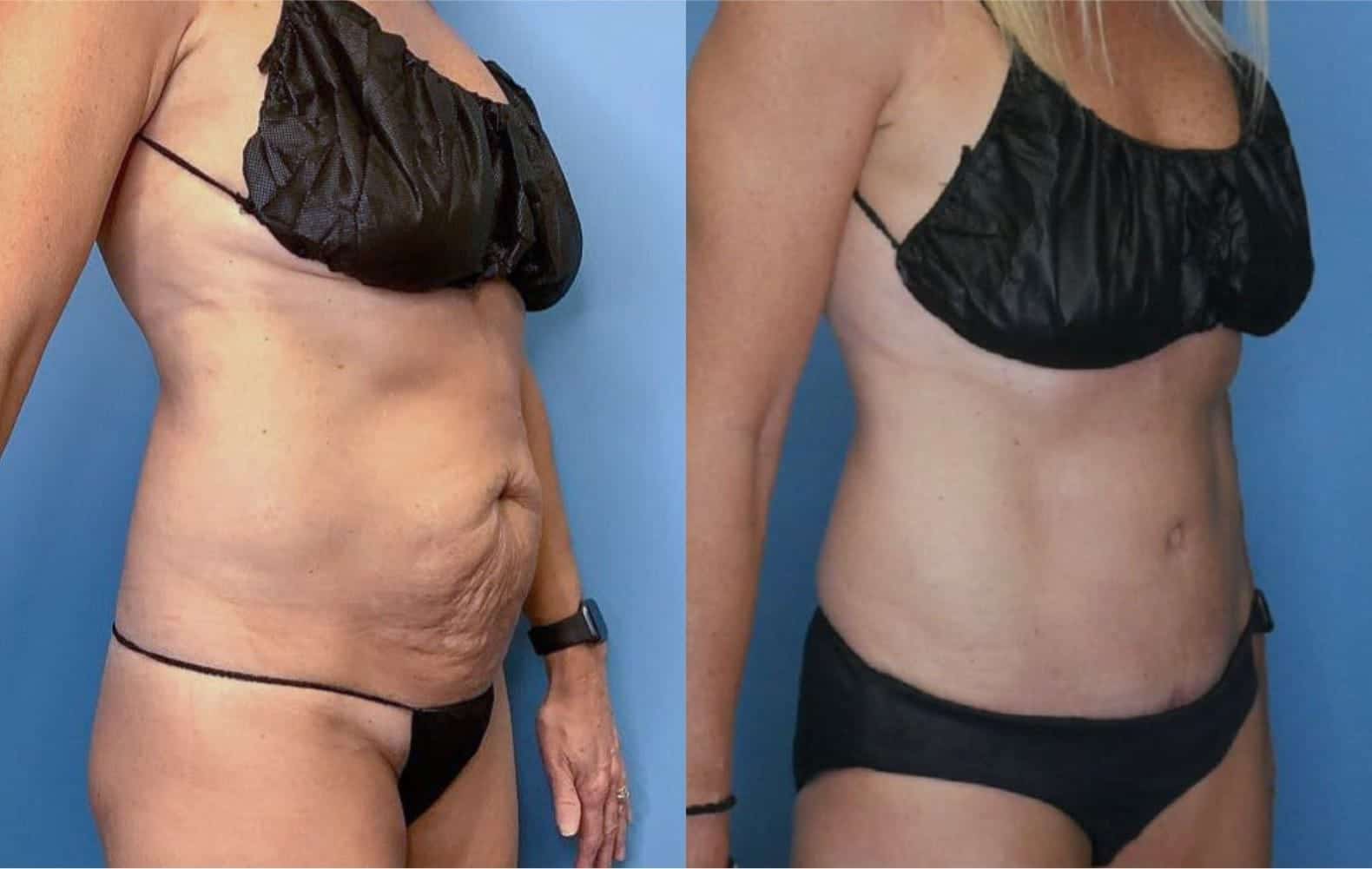 Tummy Tuck Landing Page