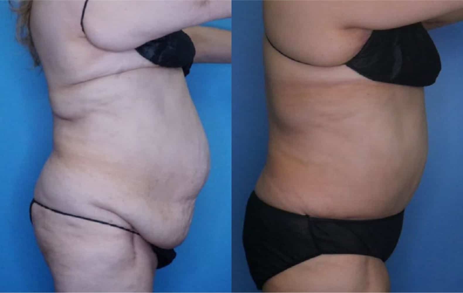 Tummy Tuck Landing Page