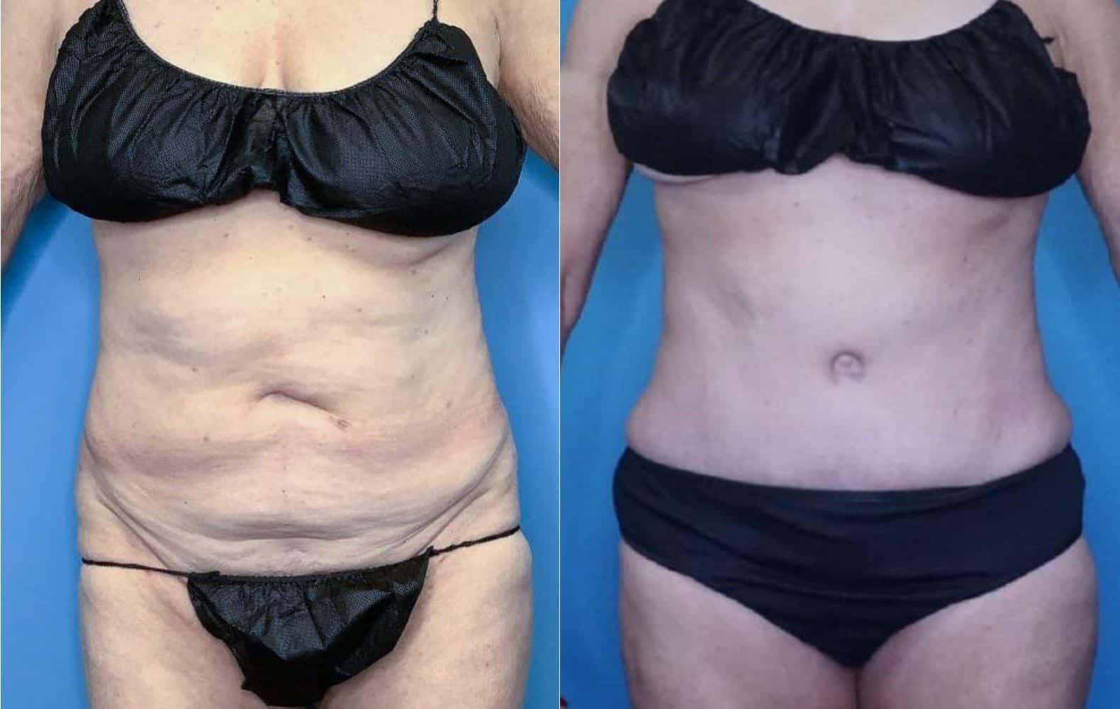 Tummy Tuck Landing Page