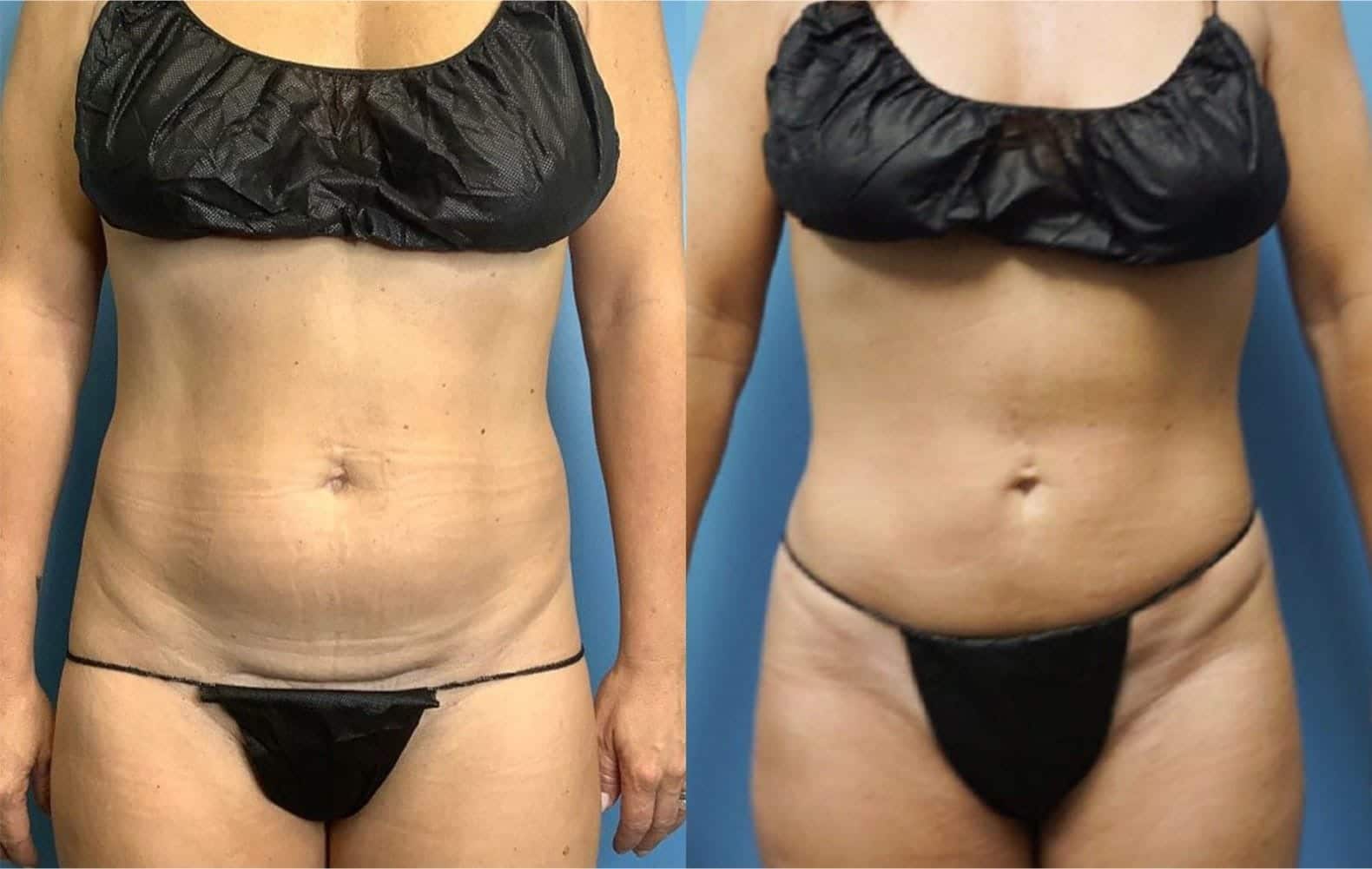 Body Contouring After Weight Loss Landing Page