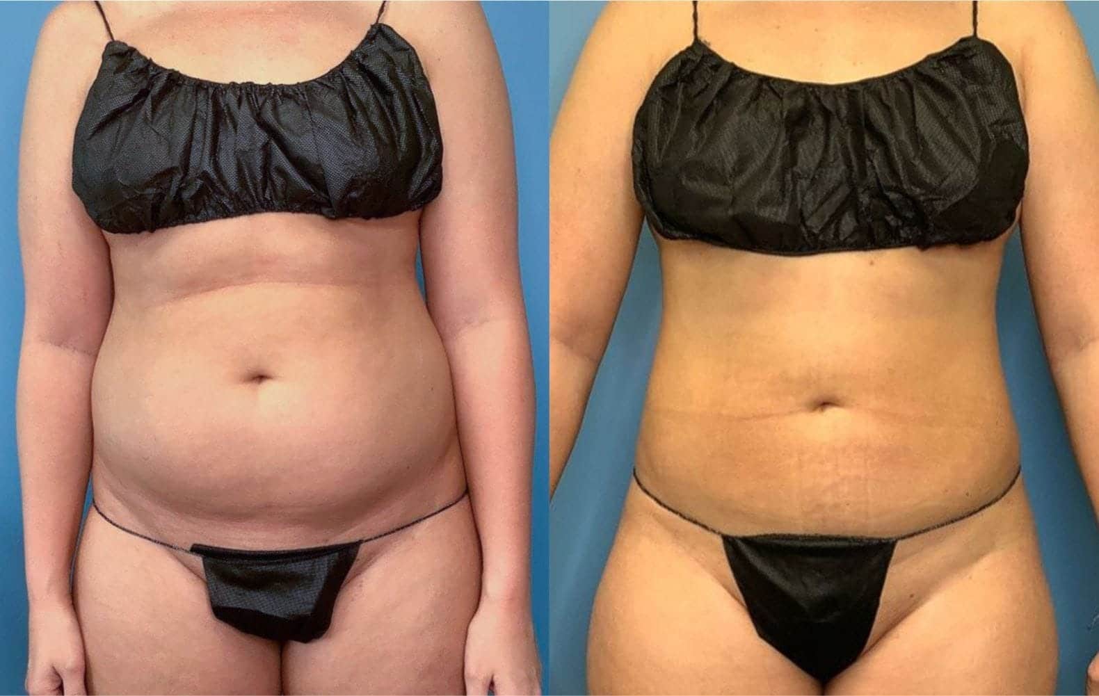 Body Contouring After Weight Loss Landing Page