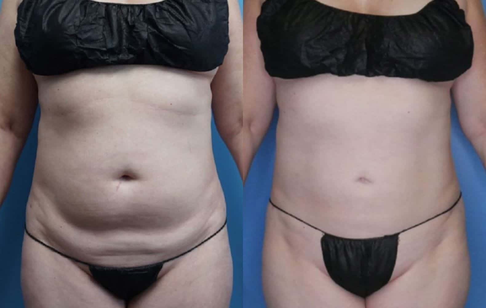 Body Contouring After Weight Loss Landing Page