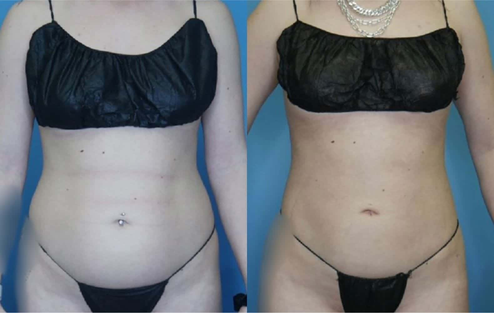 Body Contouring After Weight Loss Landing Page