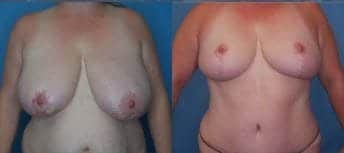Breast Procedure Landing Page