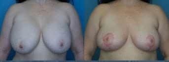 Breast Procedure Landing Page