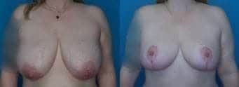 Breast Procedure Landing Page