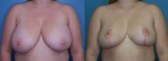 Breast Procedure Landing Page