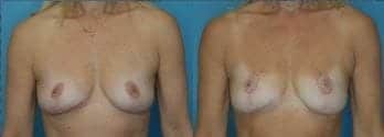 Breast Procedure Landing Page