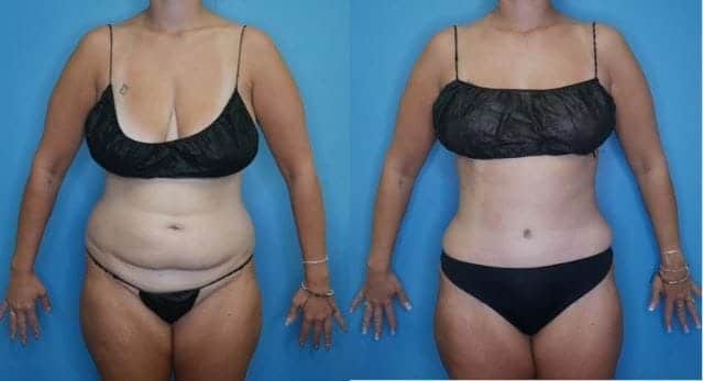 Mommy Makeover Landing Page