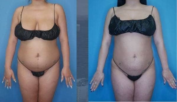 Mommy Makeover Landing Page