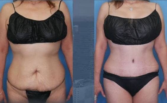 Mommy Makeover Landing Page