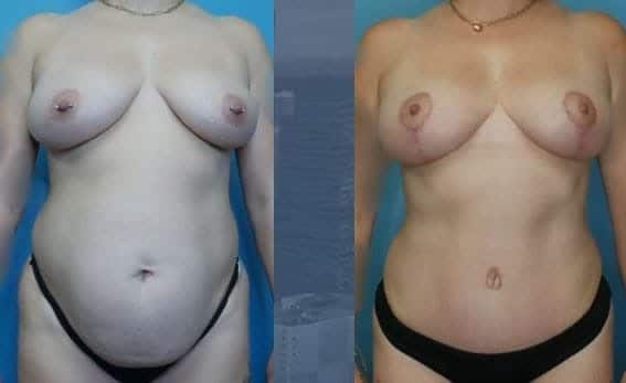 Mommy Makeover Landing Page